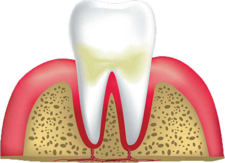 gum disease stage 2