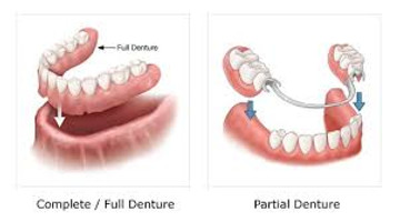 full or partial dentures, raccio and drew dental, waterford, ct