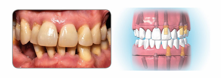 diem 2, immediate full arch restoration, implants, raccio and drew dental