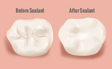 dental sealant, pediatric sealant