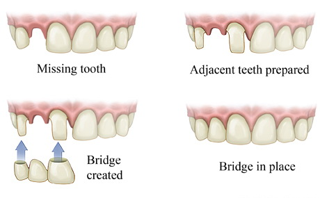 dental bridge, raccio and drew dental, waterford, ct