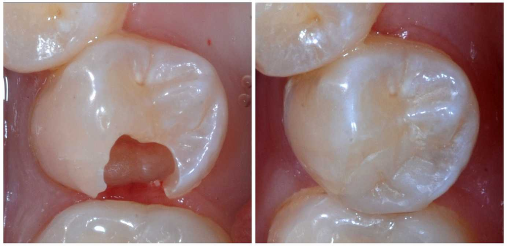 dental fillings, dental restoration